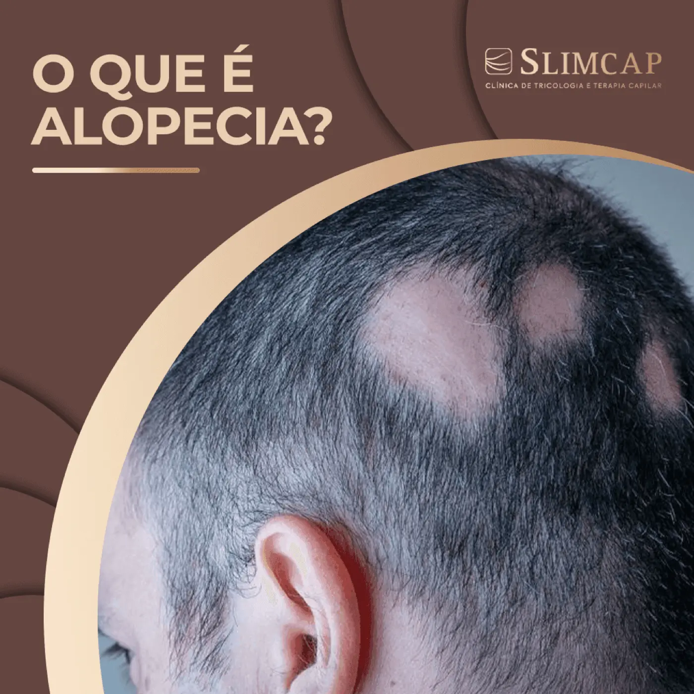 O que é alopecia? Como identificar e tratar?