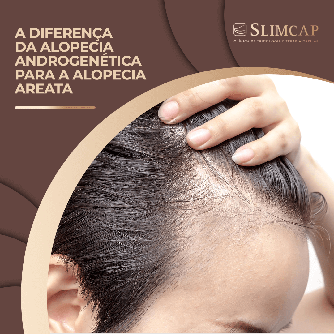 A Diferen A Da Alopecia Androgen Tica Para A Areata Blog Slim Capilar